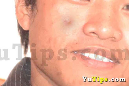 8 Cara Menghilangkan Jerawat Batu Secara Cepat Dan Alami